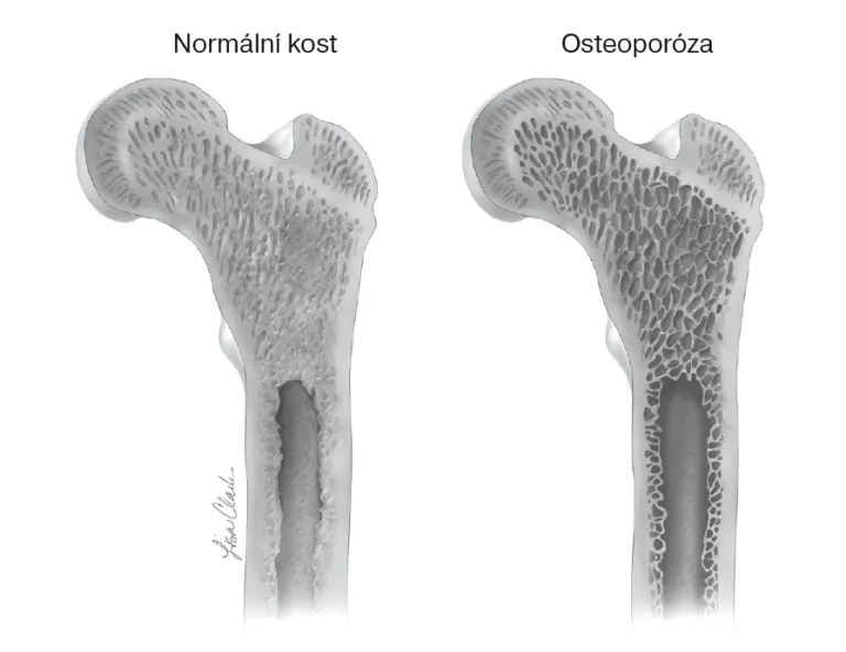 Normální kost vs. osteoporóza